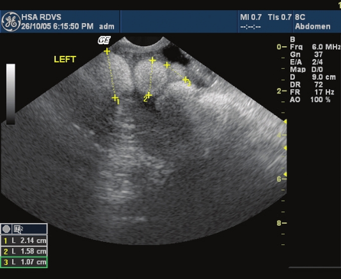 Ultrasound